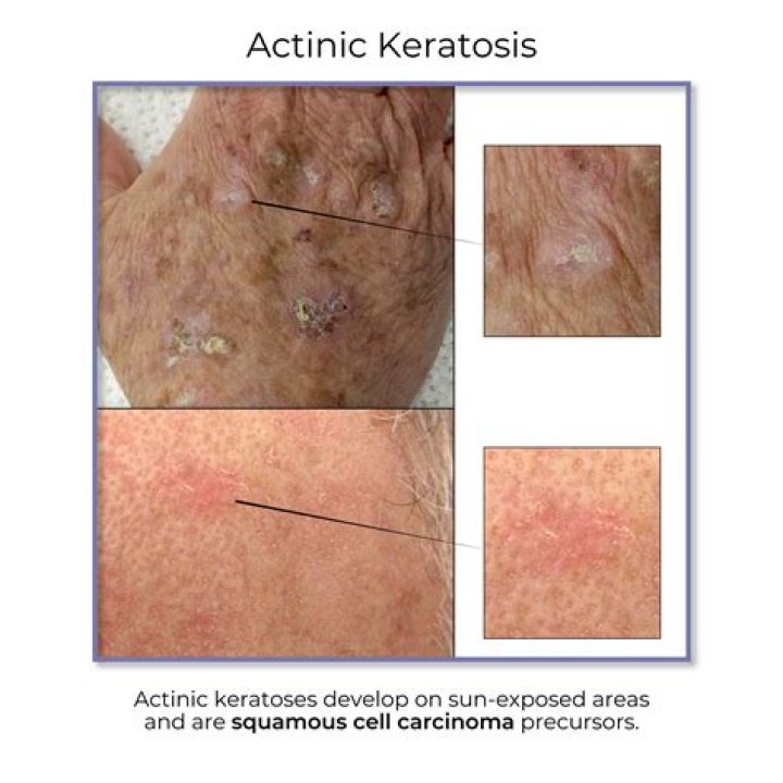 Can a keratosis itch?