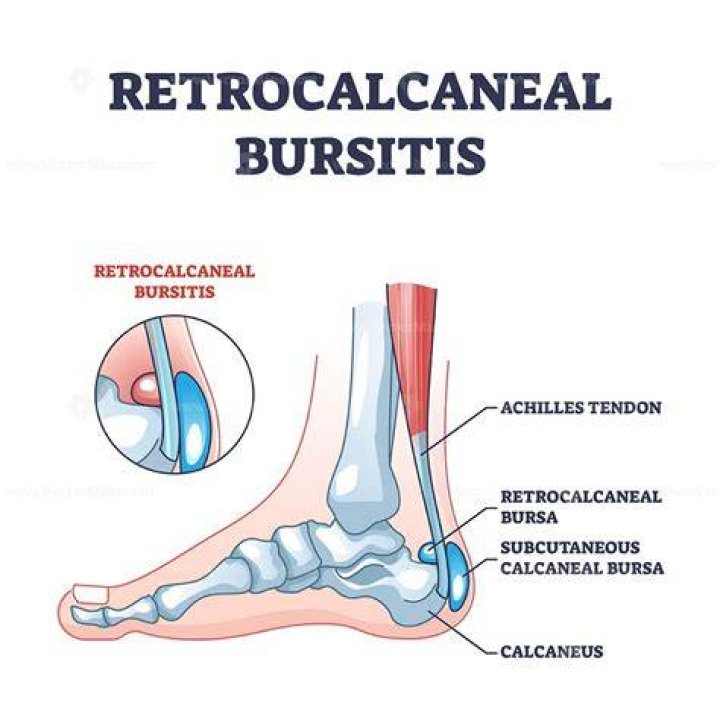 Can you heal bursitis naturally?