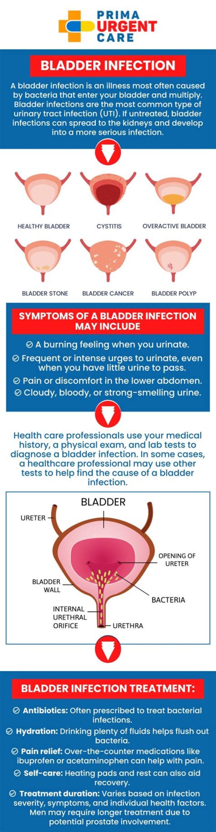 What mimics a bladder infection?